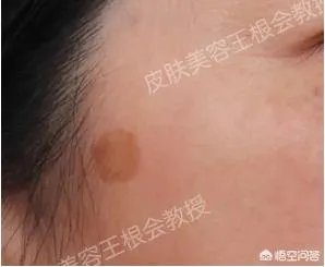 如何判断是不是得了扁平疣？