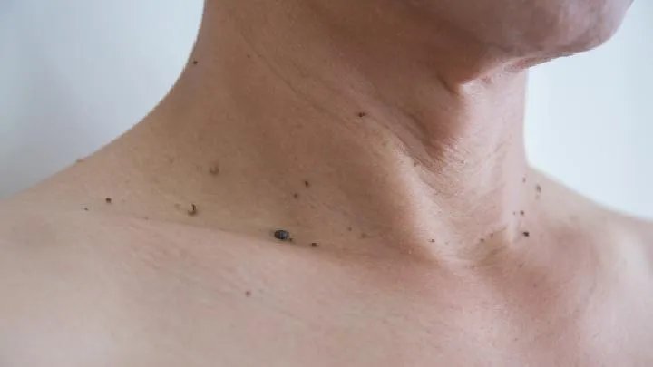 炎症反应在痤疮发病中的作用