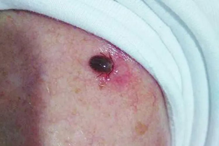 蜱虫咬人后的伤口图