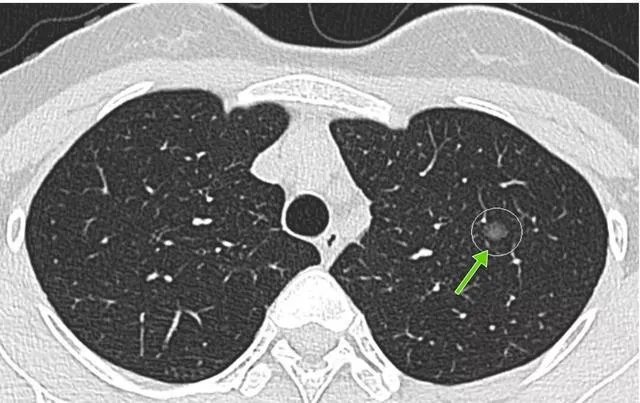 肺结节是怎么回事？