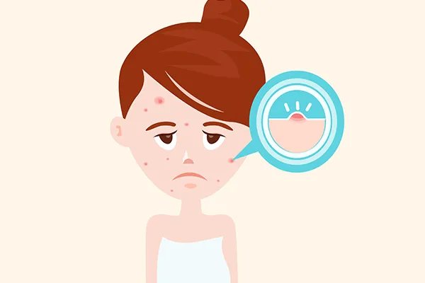 痘痘反复长是什么原因