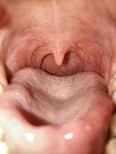 舌癌的早期症状?