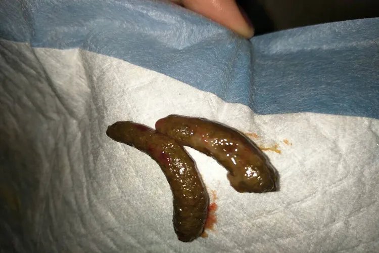 早期肠癌大便图片