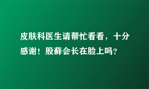 皮肤科医生请帮忙看看，十分感谢！股藓会长在脸上吗？