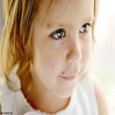 水痘有什么症状 怎么判断是不是水痘