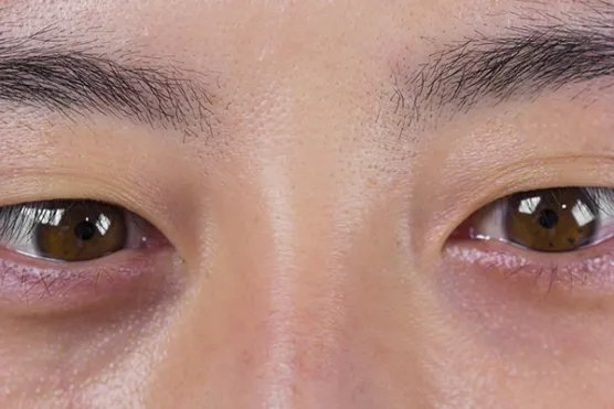 眼睛长针眼怎么办