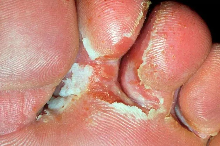 脚癣图片怎么治疗