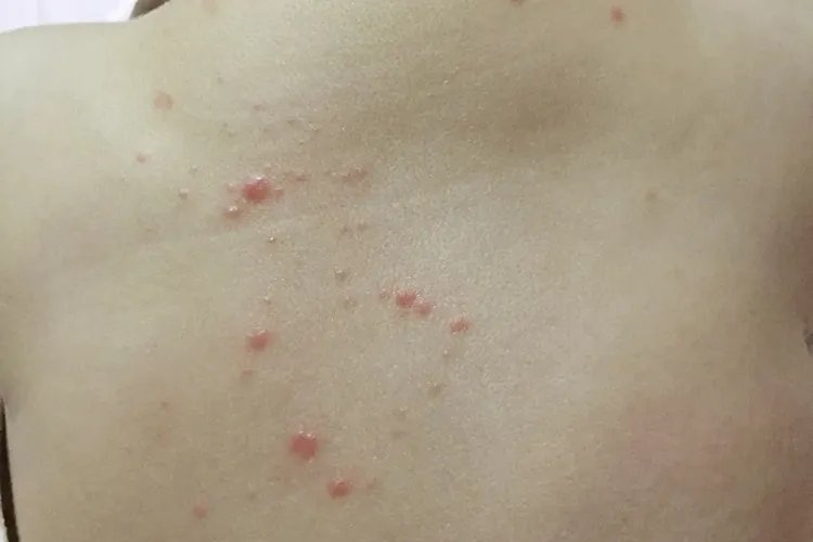 孩子10岁身上起红疙瘩很痒图片