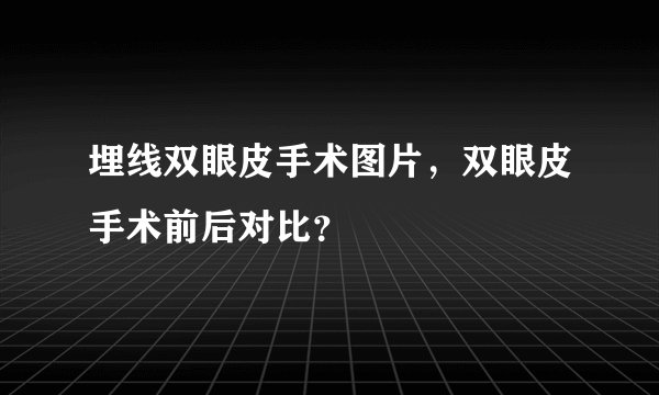 埋线双眼皮手术图片，双眼皮手术前后对比？