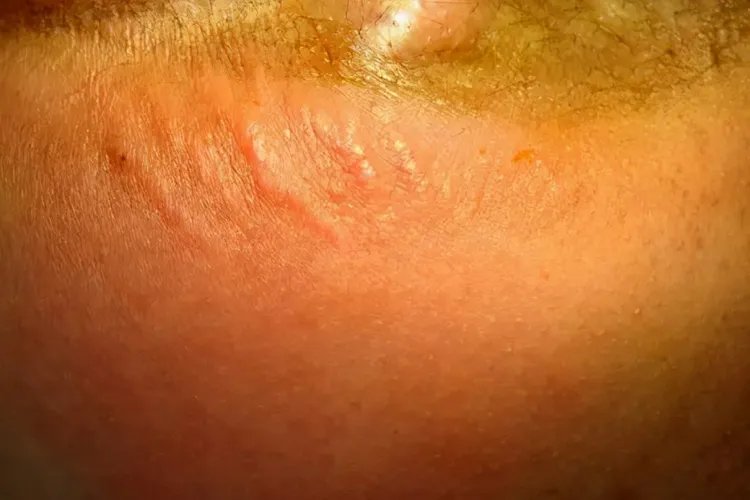 肛瘘早期什么样子图片大全