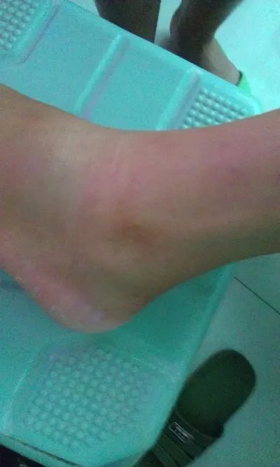 骨裂的症状主要表现为什么？