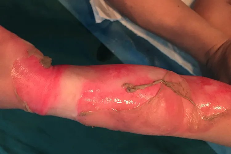 烧伤程度怎么划分标准图片