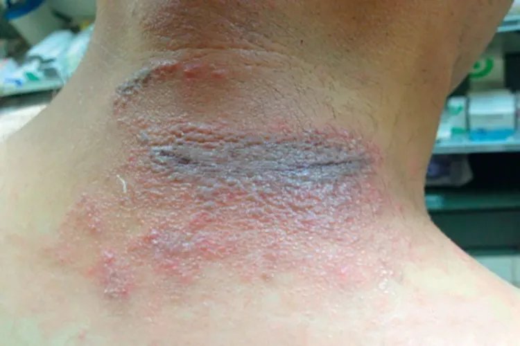 隐翅虫皮炎图片