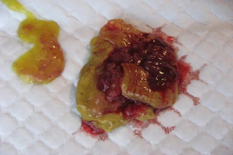 早期肠癌大便图片