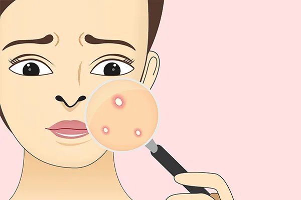 痘痘反复长是什么原因