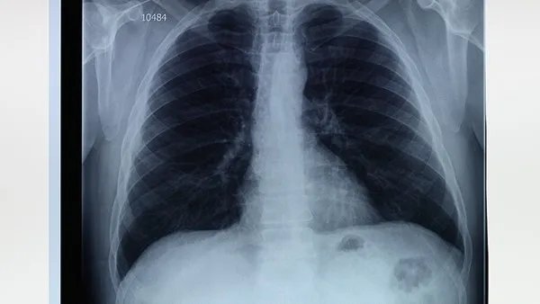 大白肺的症状是什么样 感染白肺会有什么表现