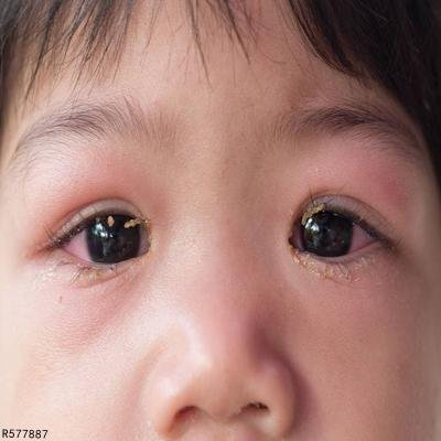 斜视如何治疗  4个方法教你矫正斜视