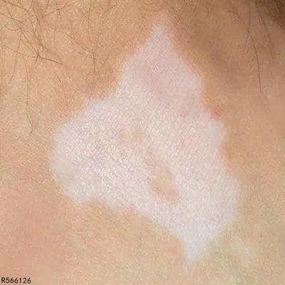 治疗白癜风用什么药