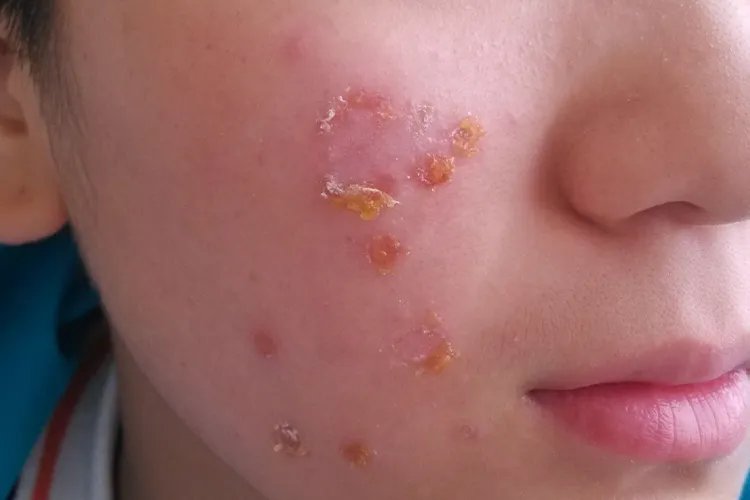 脓疱疮的初期图片