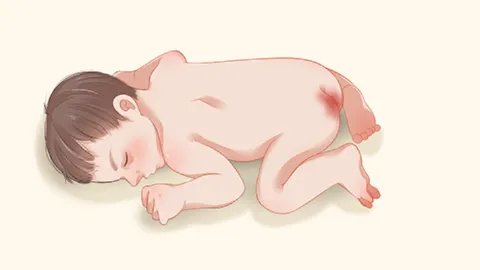 胆碱性荨麻疹有什么危害