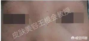 如何判断是不是得了扁平疣？