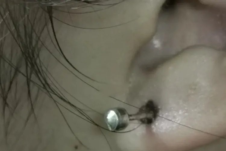 银耳钉接触肉的位置变黑