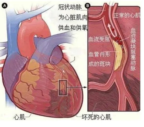 英雄机长去世，曾驾机迫降救2百人，他是因何去世的？