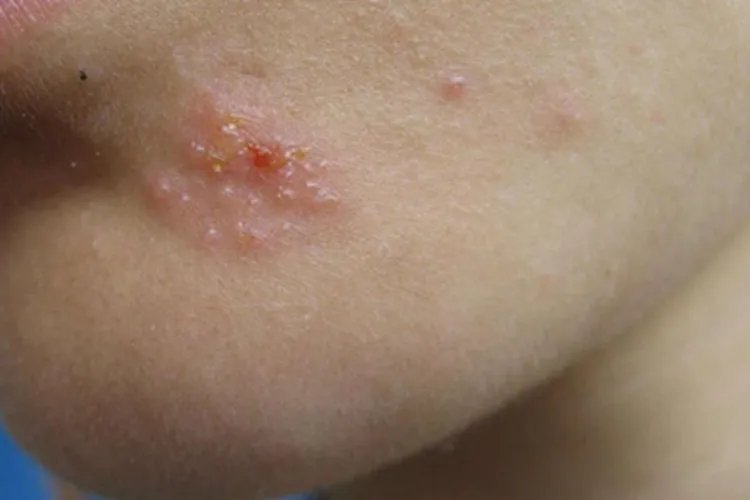 单纯疱疹症状图片