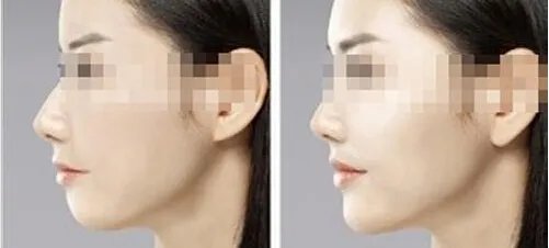 苏州下巴歪矫正美容整形医院有哪些名单_口碑哪里好点击一览