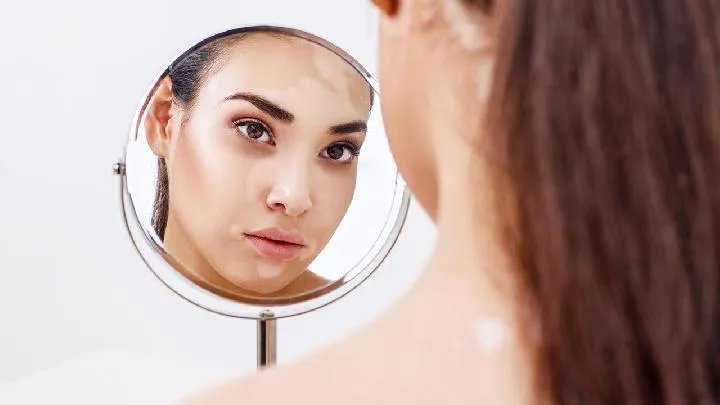 白化病如何治疗呢