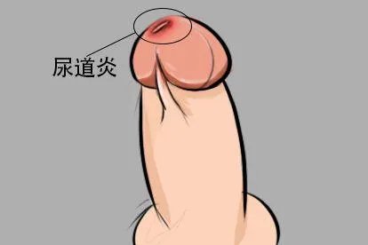 尿道口红肿是什么原因图片