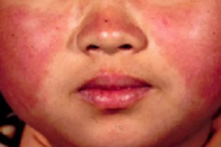 系统性红斑狼疮症状图片