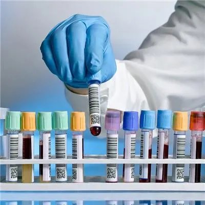 铁蛋白高是怎么回事