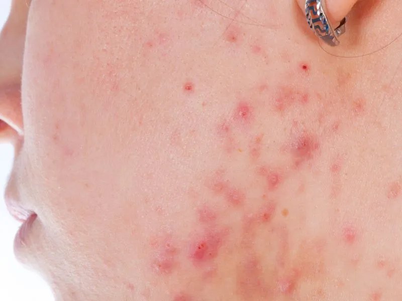 祛痘印最有效的方法有哪些