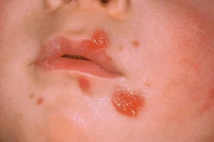 脓疱疮的初期图片