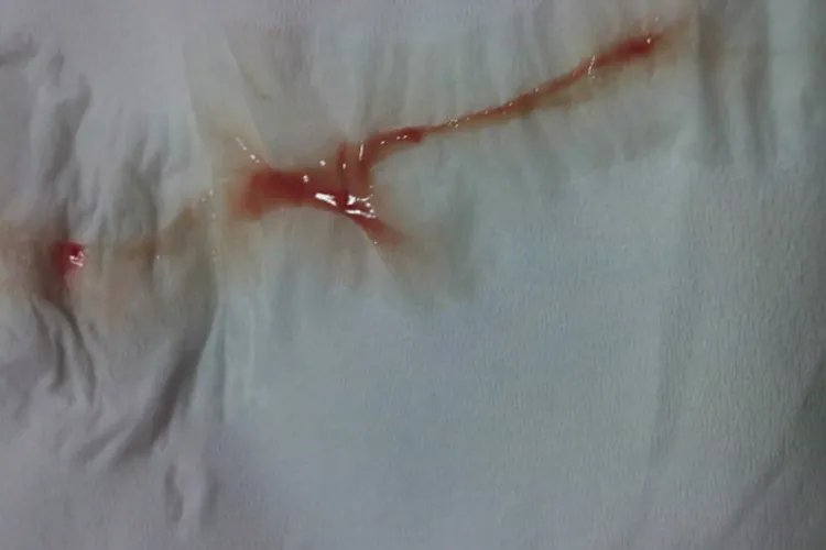 宫颈癌出血真正图片