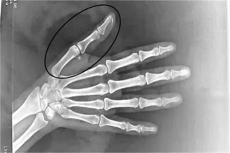 大拇指骨头图片大全