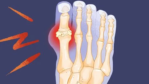 血尿酸高怎么办