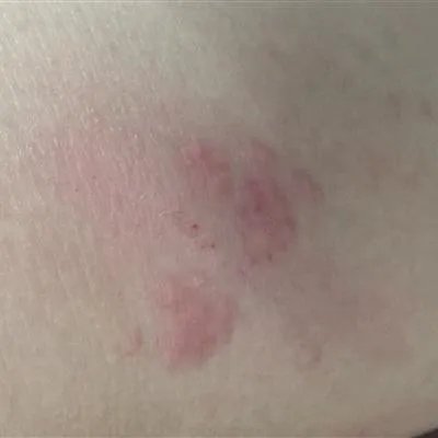 药物性皮炎怎么办?