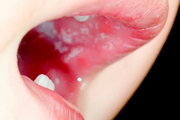 婴儿鹅口疮最早期图片