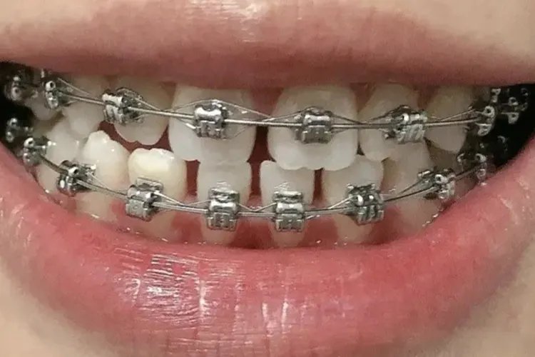 各种牙套的样子图片