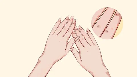 胆碱性荨麻疹有什么危害