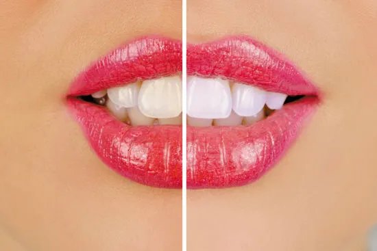 如何使牙齿变白