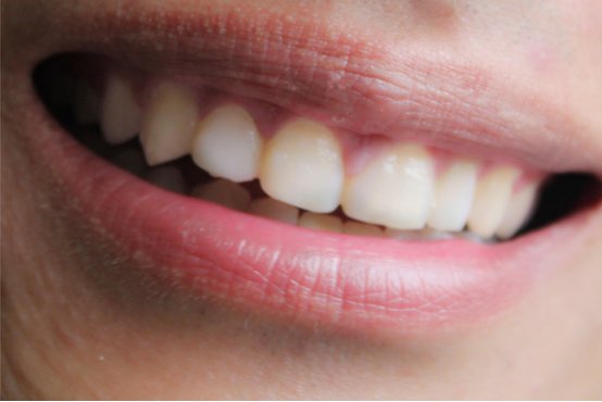 牙结石怎么去除