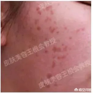 如何判断是不是得了扁平疣？