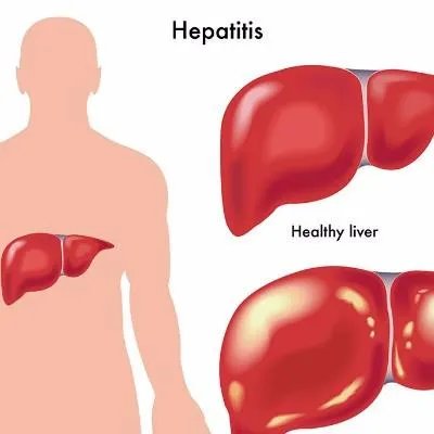 恩度治肝癌的效果