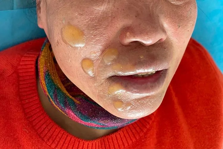 烧伤程度怎么划分标准图片