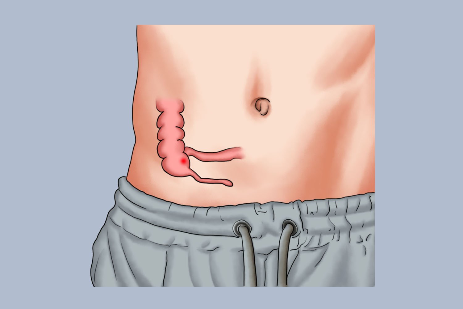 男性阑尾炎症状疼痛位置图