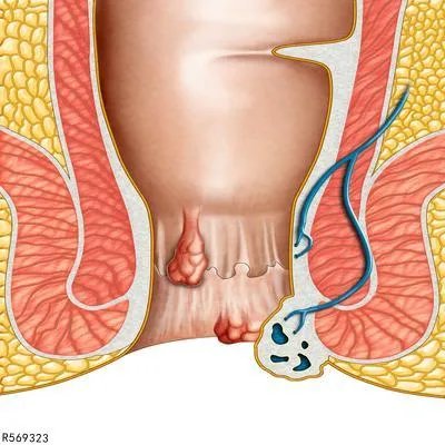 内痔初期怎么治疗