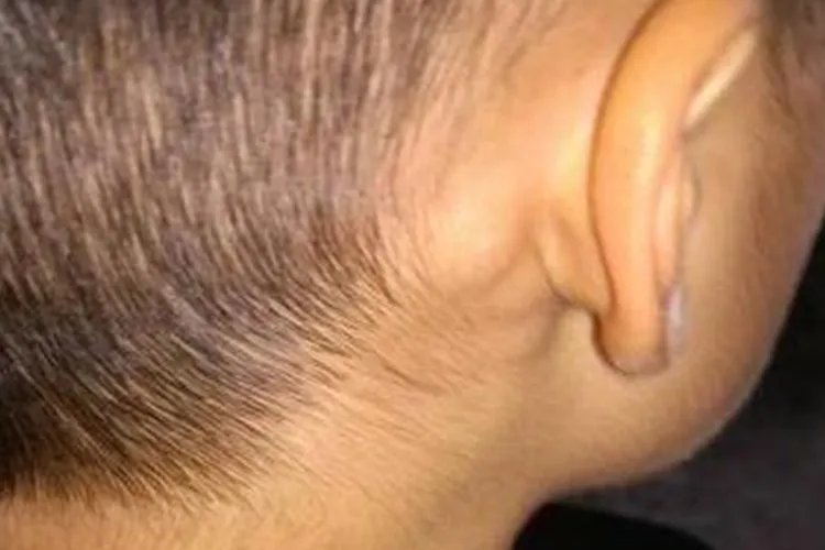 耳后淋巴结肿大图片